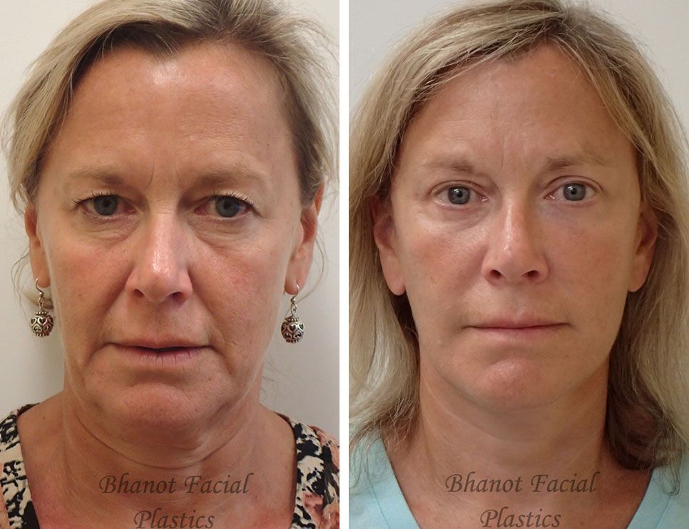 A before and after photo of a woman's face.