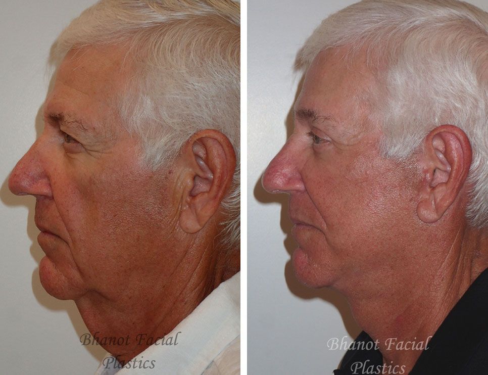Pre and Post Deep Plane Facelift Browlift Upper Lower Blepharoplasty
