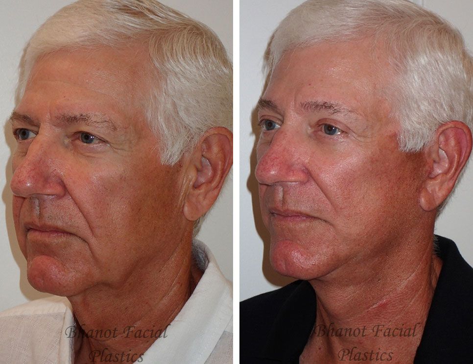 A before and after photo of a man's face.