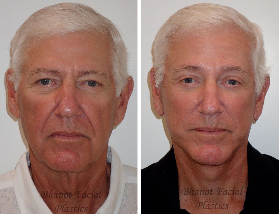 A before-and-after photo of a man's face.