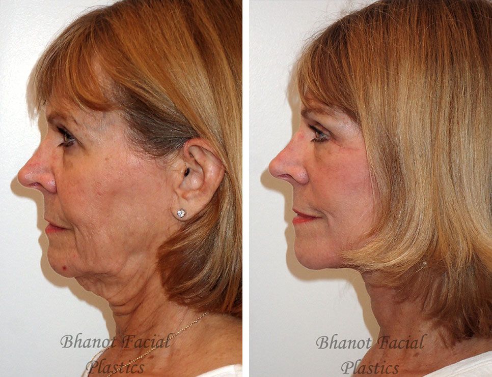 Pre and Post Deep Plane Facelift Upper Lower Blepharoplasty