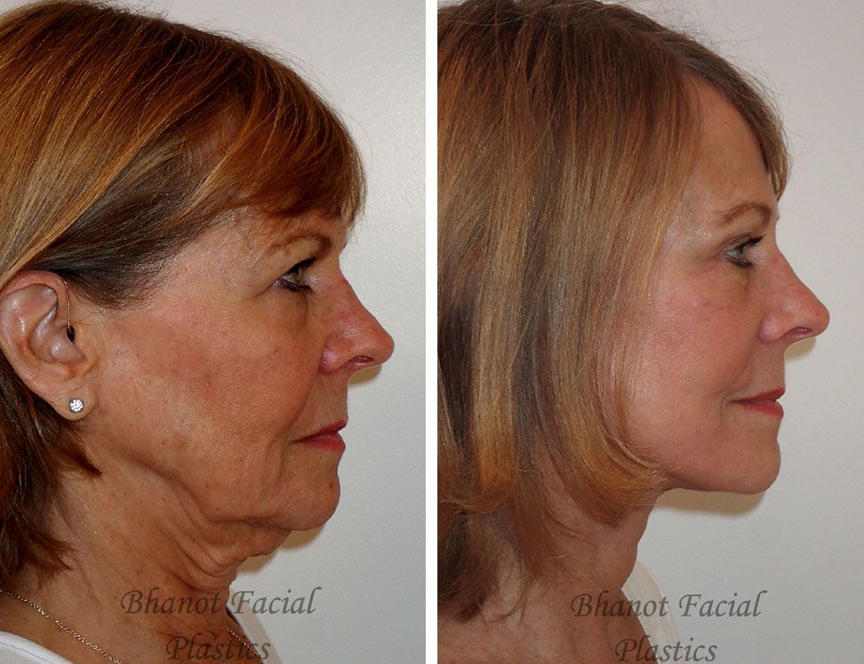 A before and after photo of a woman's face and neck.