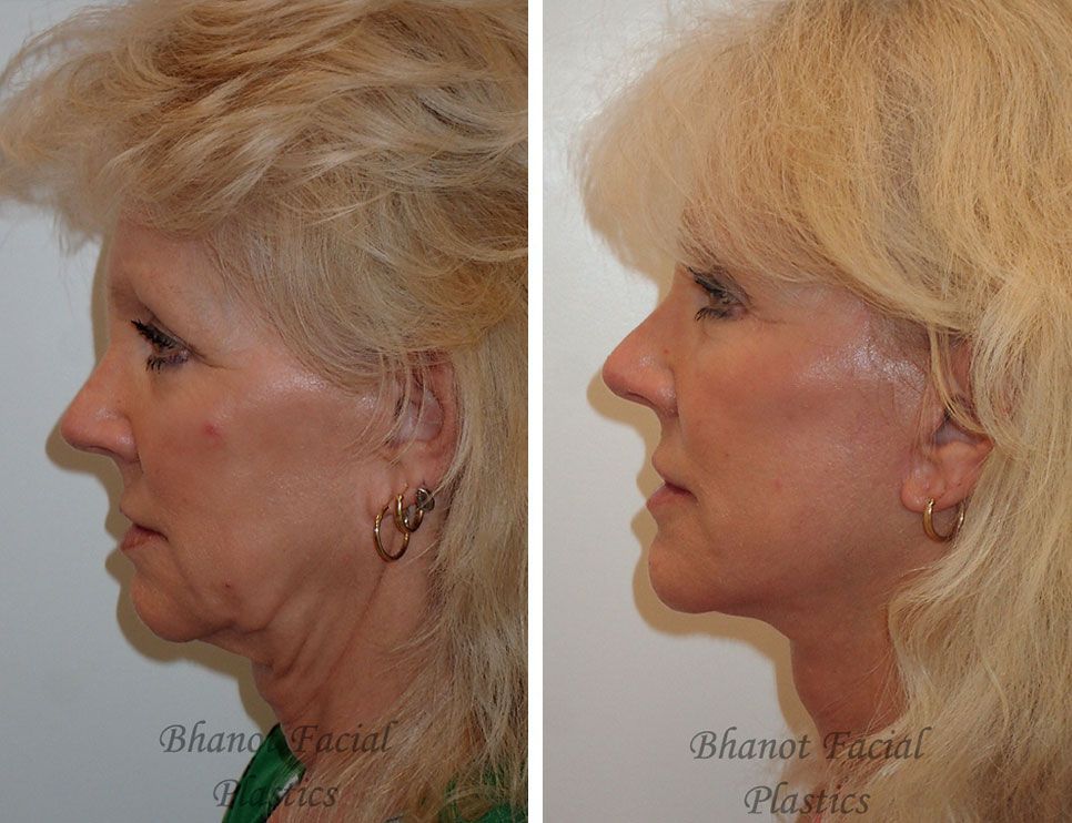 Pre and Post Deep Plane Facelift Browlift Lower Blepharoplasty