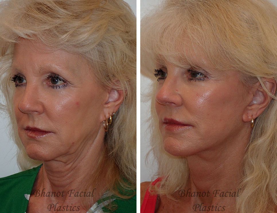 A before and after photo of a woman's face and neck.