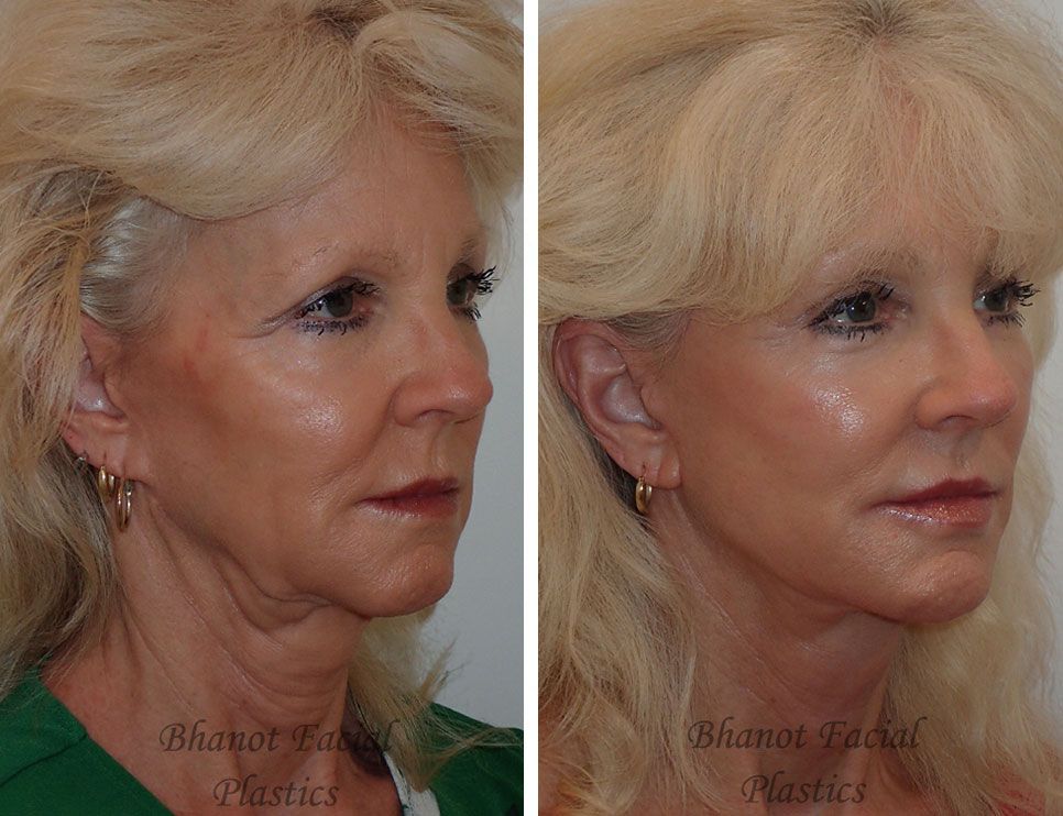 Deep Plane Facelift, Browlift, Lower Blepharoplasty procedure