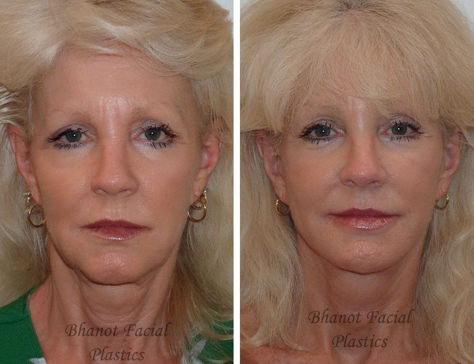 Before and after Deep Plane Facelift Browlift Lower Blepharoplasty