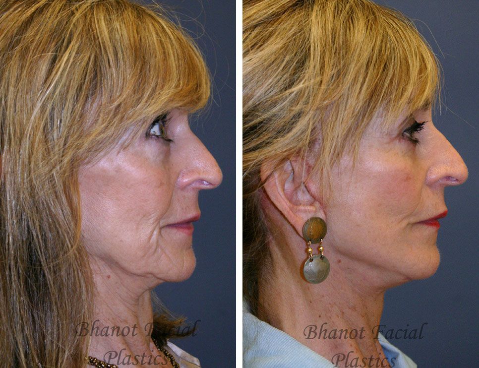 Pre and Post Deep Plane Facelift Browlift Lower Blepharoplasty