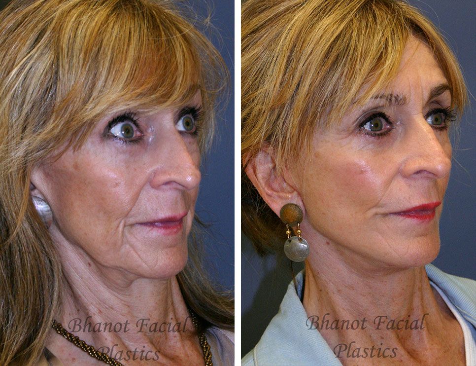A before and after photo of a woman's face.