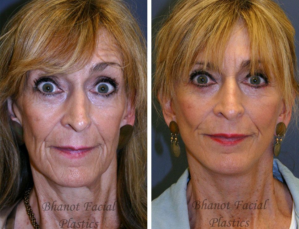 Before and after Deep Plane Facelift Browlift Lower Blepharoplasty procedure