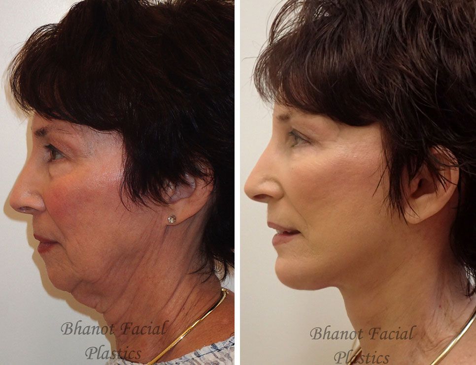 Pre and Post Deep Plane Facelift Browlift Upper Lower Blepharoplasty Chin Implant
