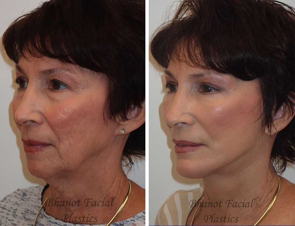 Before and after Deep Plane Facelift Browlift Upper Lower Blepharoplasty Chin Implant