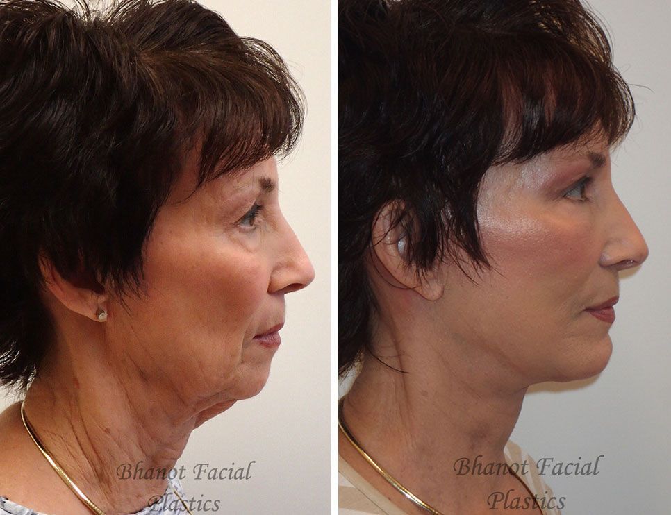 Deep Plane Facelift Browlift Upper Lower Blepharoplasty Chin Implant Results