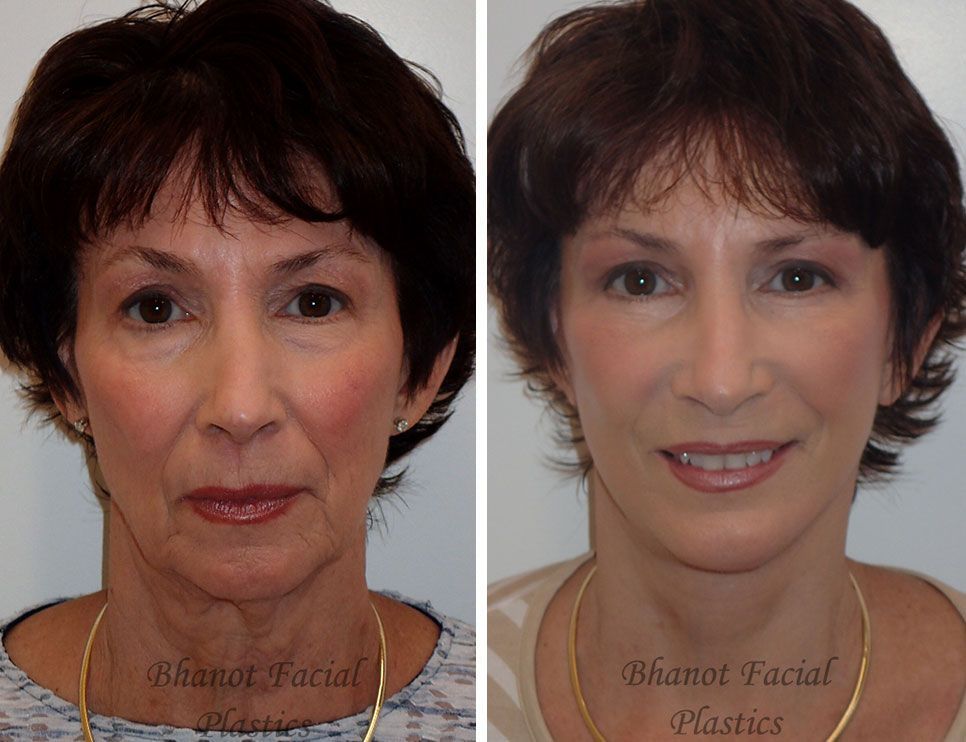 Pre and Post Deep Plane Facelift Browlift Upper Lower Blepharoplasty Chin Implant Results