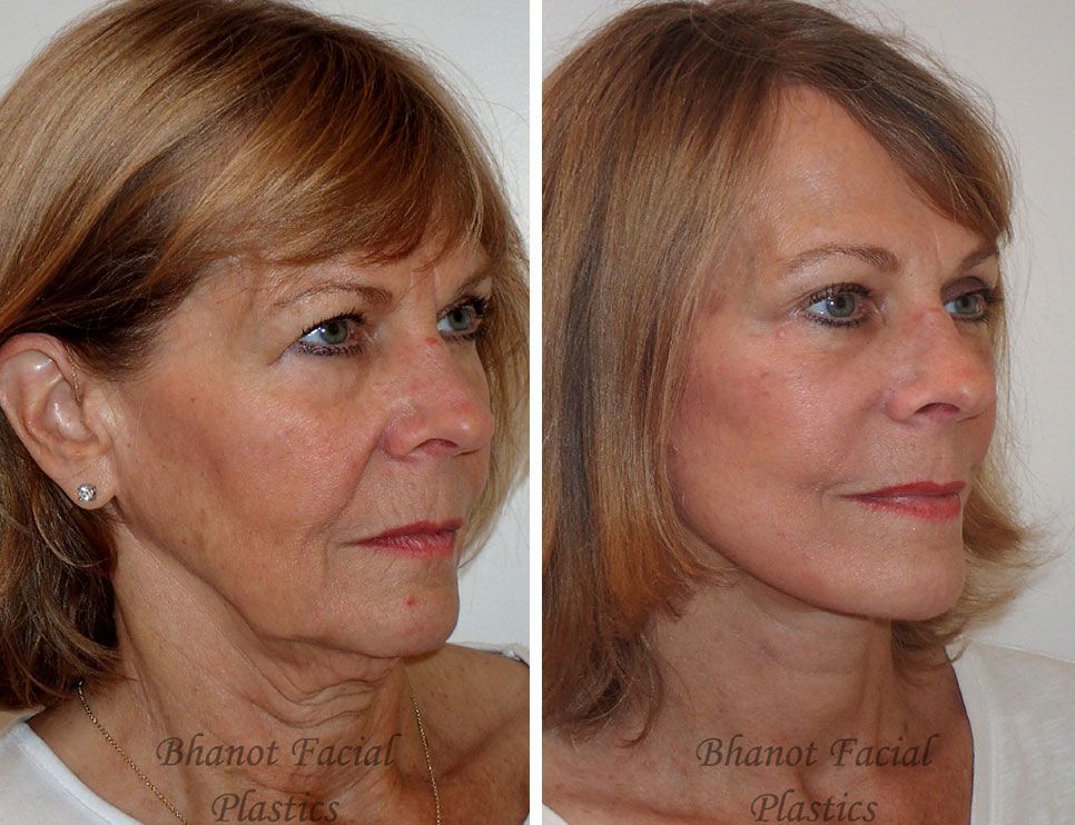 Before and after Deep Plane Facelift Upper Lower Blepharoplasty