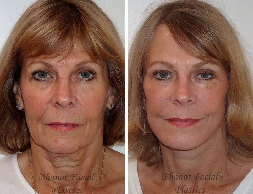 Deep Plane Facelift Upper Lower Blepharoplasty procedure