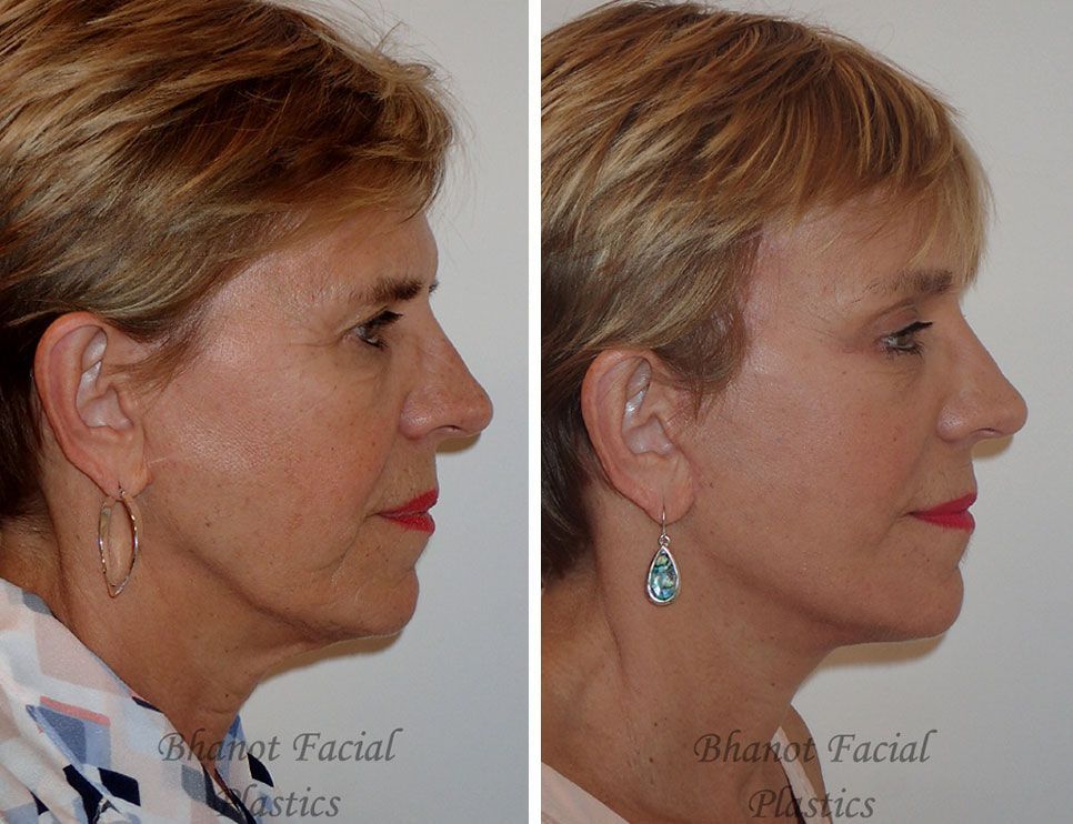 Pre and Post Deep Plane Facelift Browlift Lower Blepharoplasty