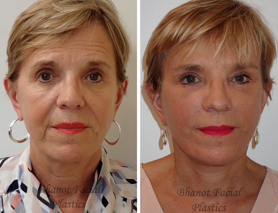 Pre and Post Deep Plane Facelift Browlift Lower Blepharoplasty procedure