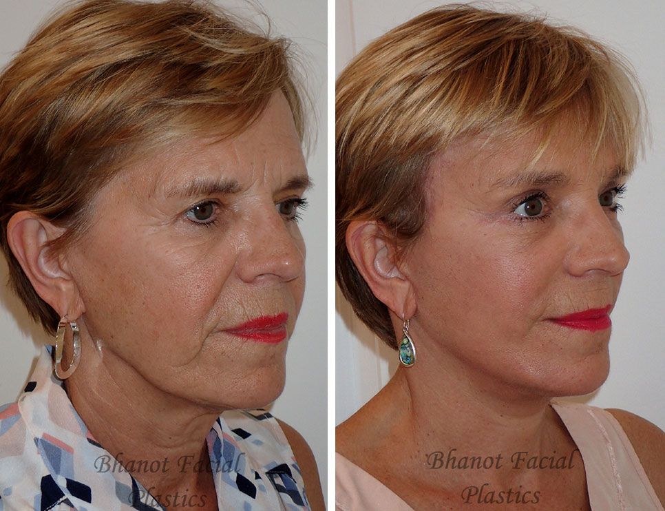 Before and after Deep Plane Facelift Browlift Lower Blepharoplasty procedure