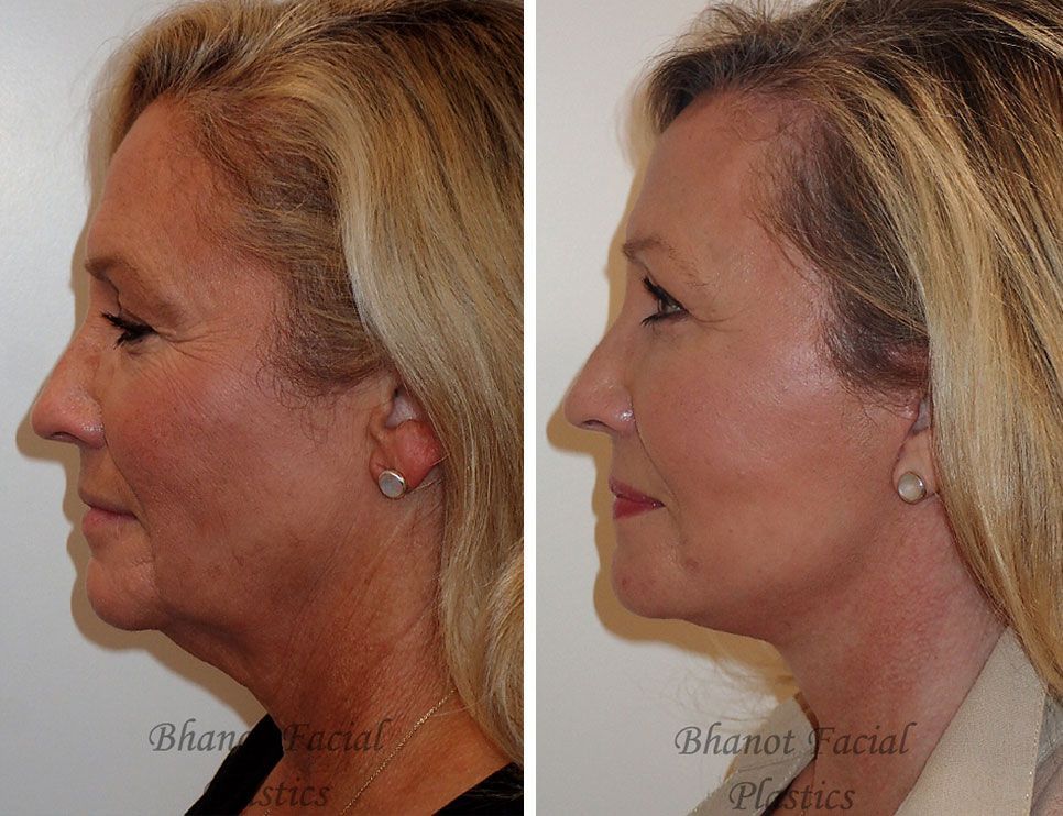 Pre and Post Deep Plane Facelift Browlift Lower Blepharoplasty