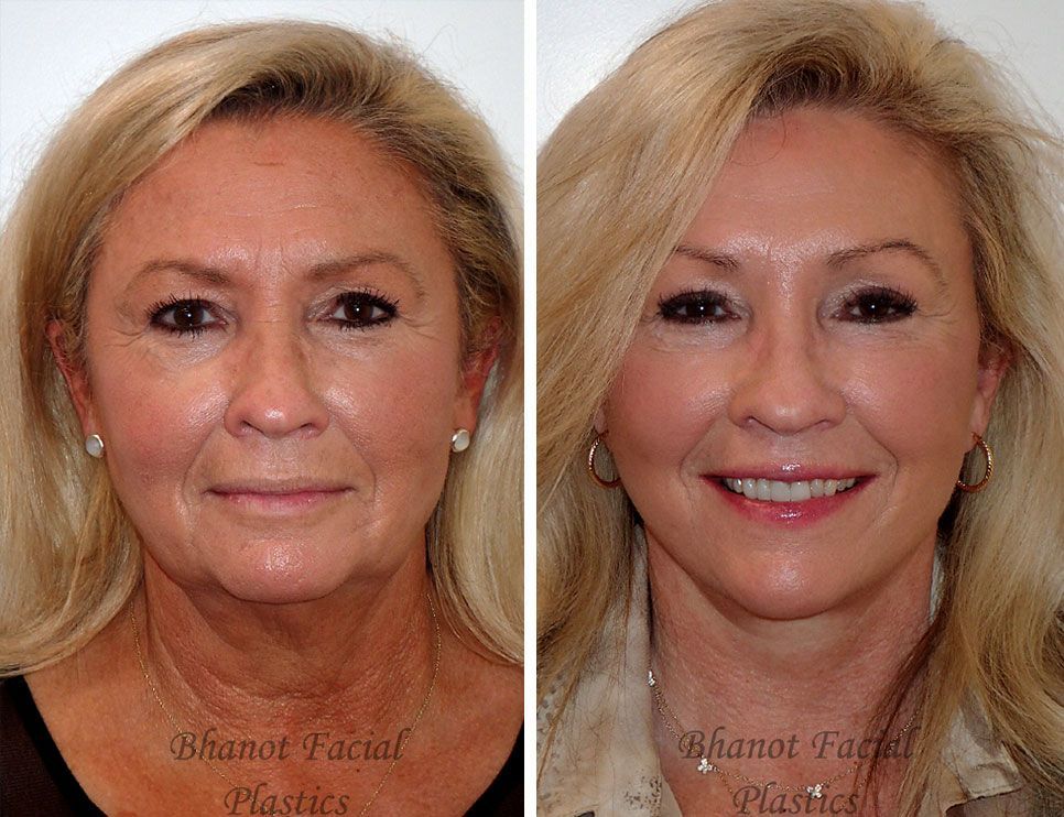 Pre and Post Deep Plane Facelift Browlift Lower Blepharoplasty procedure