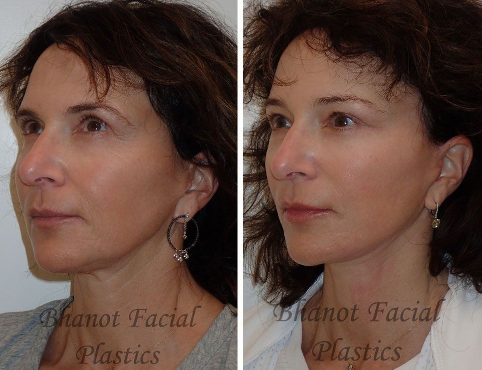 Pre and Post Deep Plane Facelift Browlift Lower Blepharoplasty