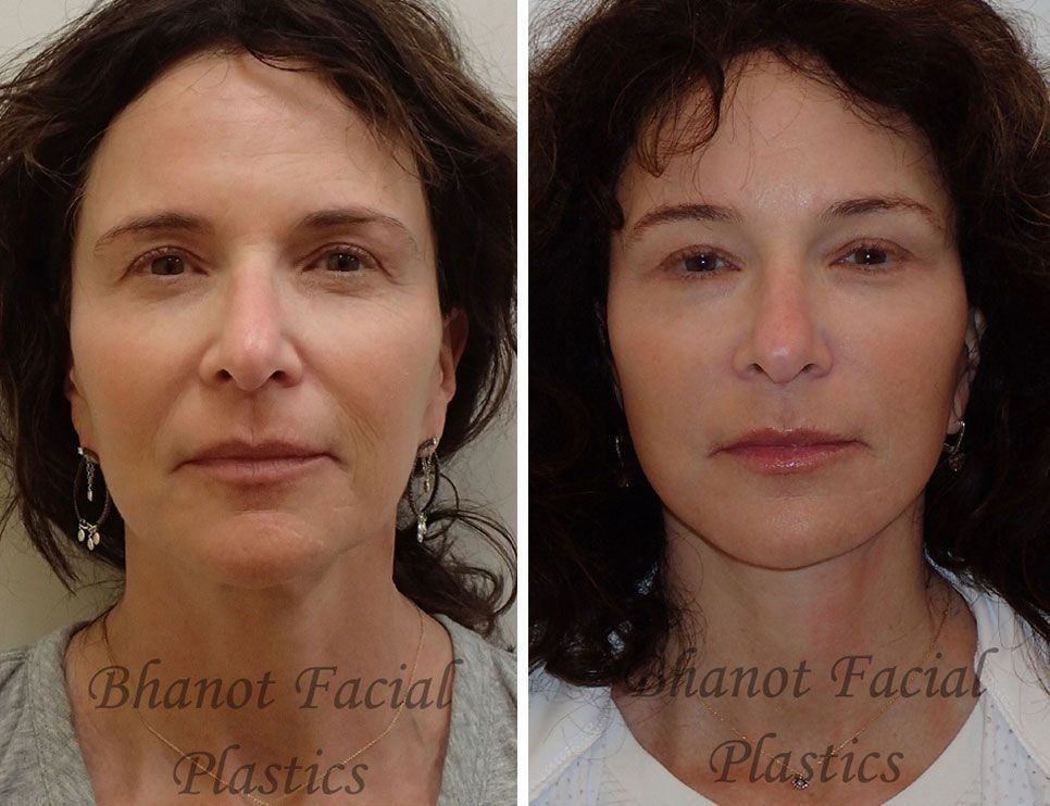 Before and after Deep Plane Facelift Browlift Lower Blepharoplasty