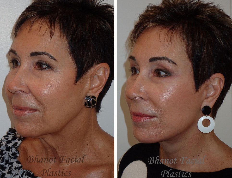 Pre and Post Deep Plane Facelift Browlift Lower Blepharoplasty