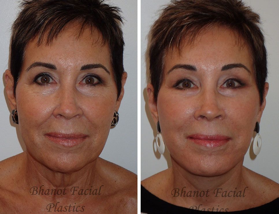 Before and after Deep Plane Facelift Browlift Lower Blepharoplasty