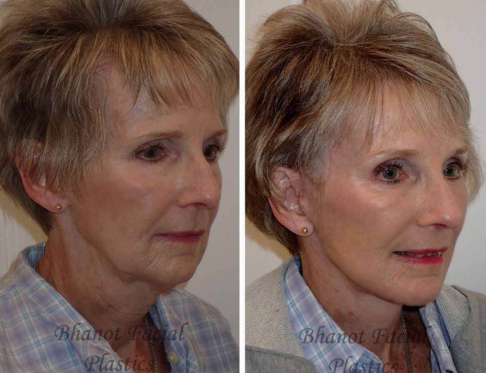 Pre and Post Deep Plane Facelift Browlift Lower Blepharoplasty