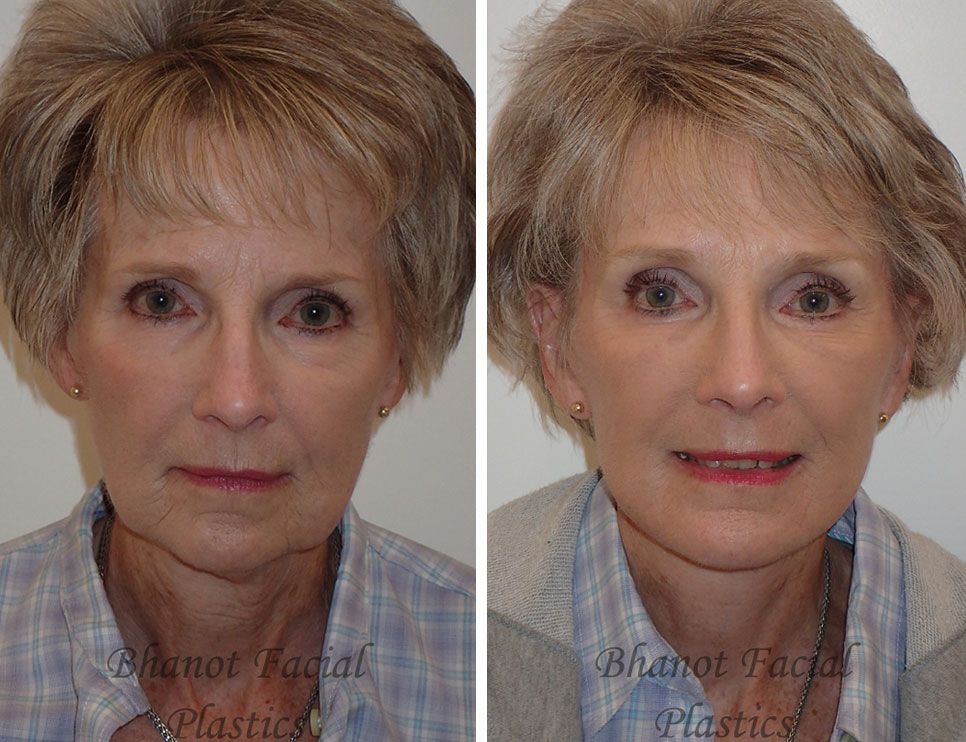 Before and after Deep Plane Facelift Browlift Lower Blepharoplasty