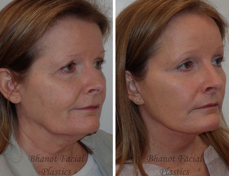 Pre and Post Deep Plane Facelift Browlift Lower Blepharoplasty