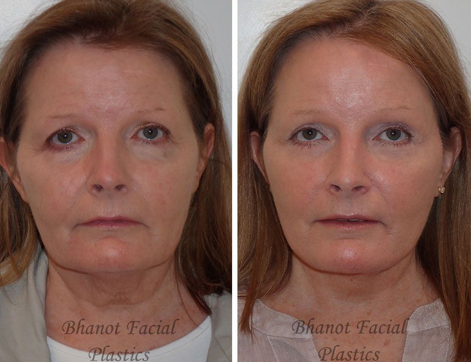 Before and after Deep Plane Facelift Browlift Lower Blepharoplasty