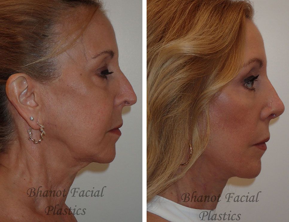 Pre and Post Deep Plane Facelift Browlift Lower Blepharoplasty Rhinoplasty