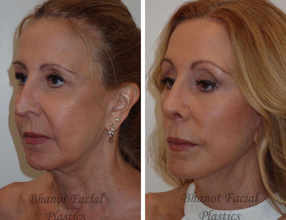 Before and After Deep Plane Facelift Browlift Lower Blepharoplasty Rhinoplasty
