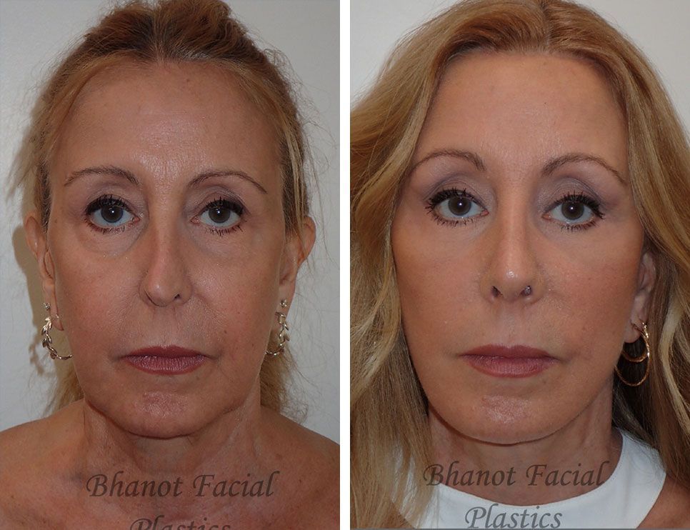 Deep Plane Facelift Browlift Lower Blepharoplasty Rhinoplasty Procedure