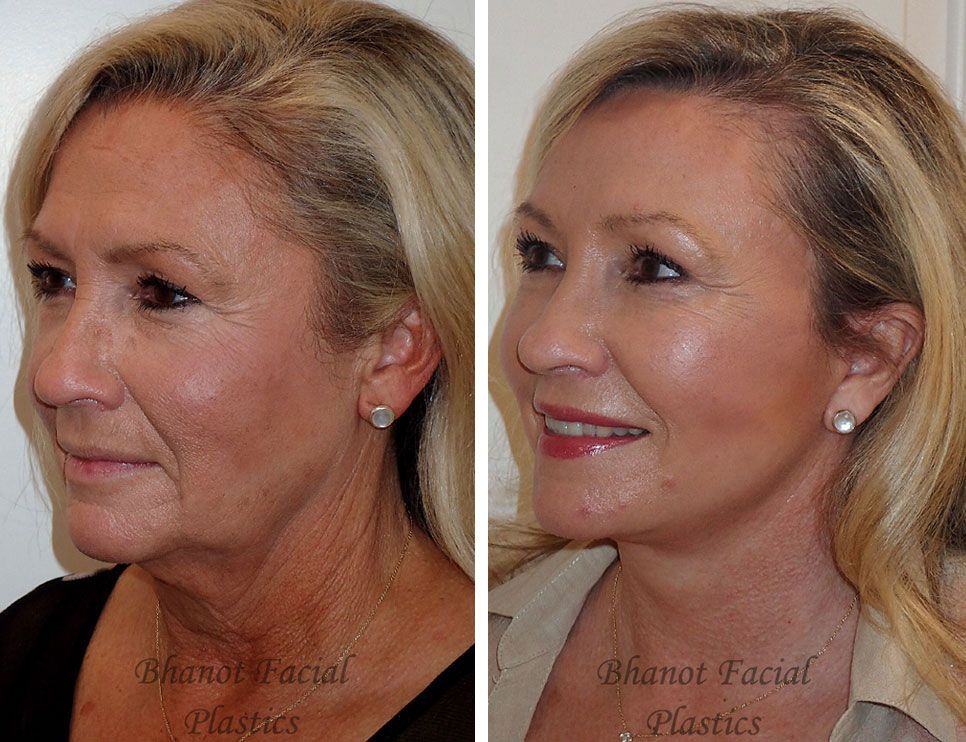 A before and after photo of a woman's face.