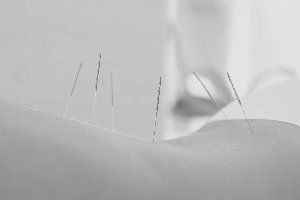 Acupuncture