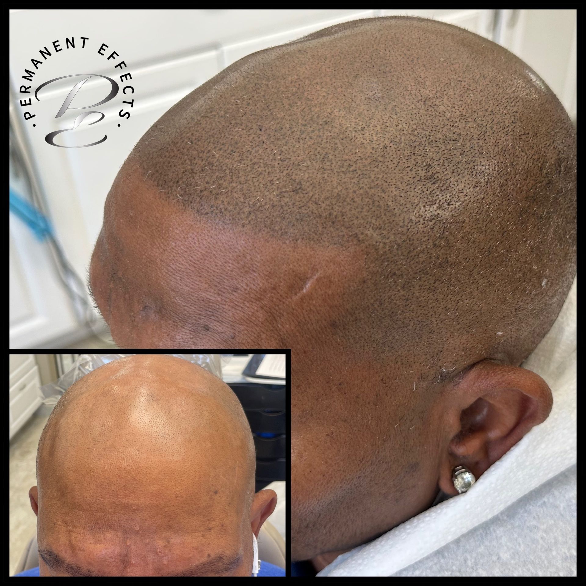 A man with a bald head has permanent effects tattooed on his head