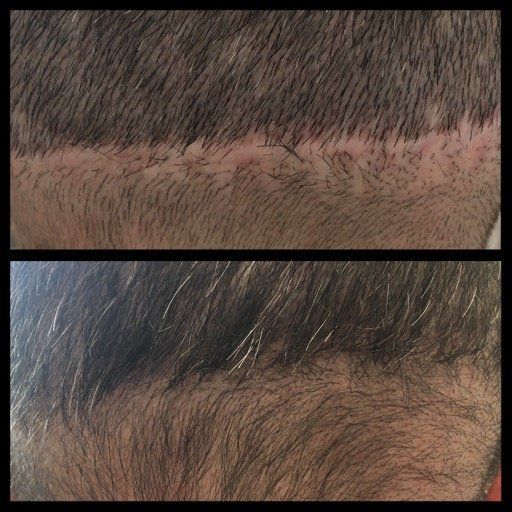 A before and after picture of a person 's hair with a scar.