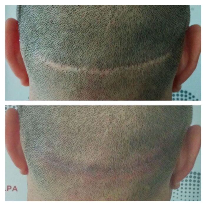 before and after image of scalp micropigmentation