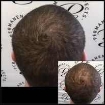 The back of a man 's head with hair loss.