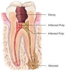 Endodontic Procedure