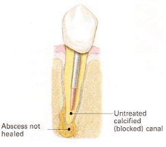endodontic retreatment