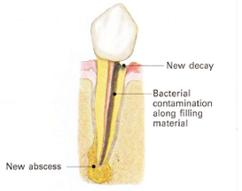endodontic retreatment