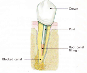 endodontic retreatment