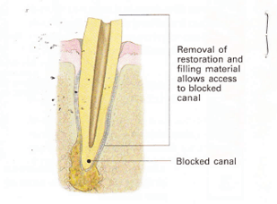 endodontic retreatment