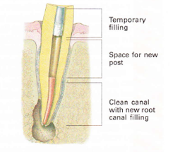 endodontic retreatment