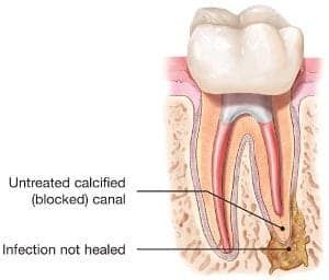 endodontic retreatment