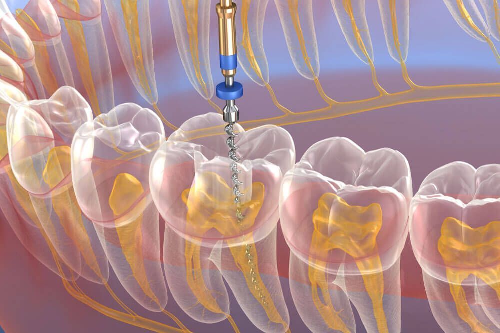 Endodontic retreatments