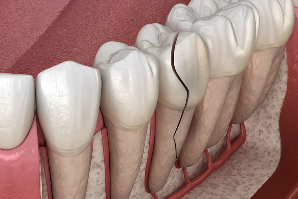 Cracked tooth treatments